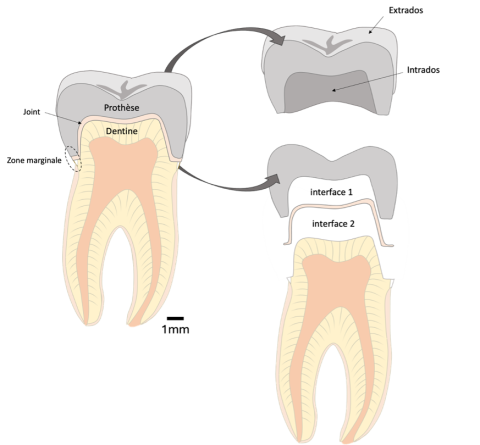 Schéma illustrant les interfaces entre dentine et prothèse, au cœur des recherches sur les restaurations dentaires.